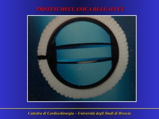 Cattedra di Cardiochirurgia – Università degli Studi di BresciaCattedra di Cardiochirurgia – Università degli Studi di Brescia
PROTESI MECCANICA BI-LEAFLETPROTESI MECCANICA BI-LEAFLET
 