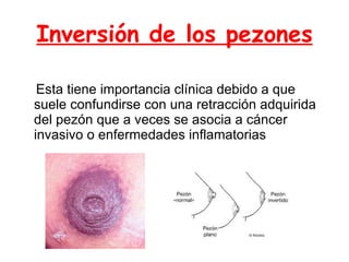 Inversión de los pezones Esta tiene importancia clínica debido a que suele confundirse con una retracción adquirida del pezón que a veces se asocia a cáncer invasivo o enfermedades inflamatorias 