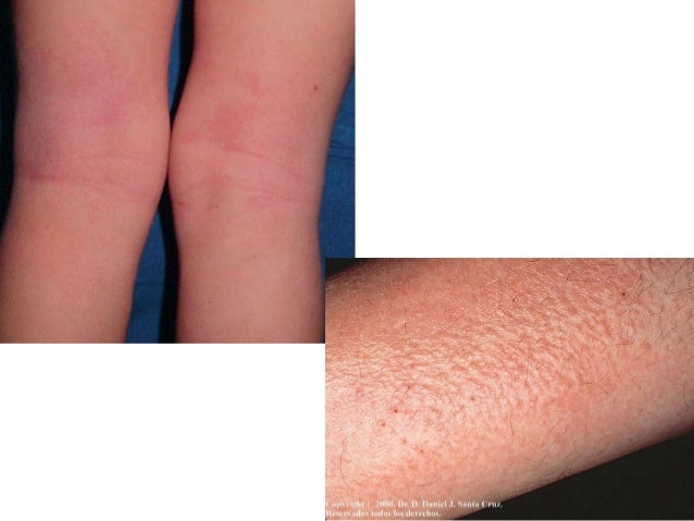 La psoriasis en los pies entre los dedos