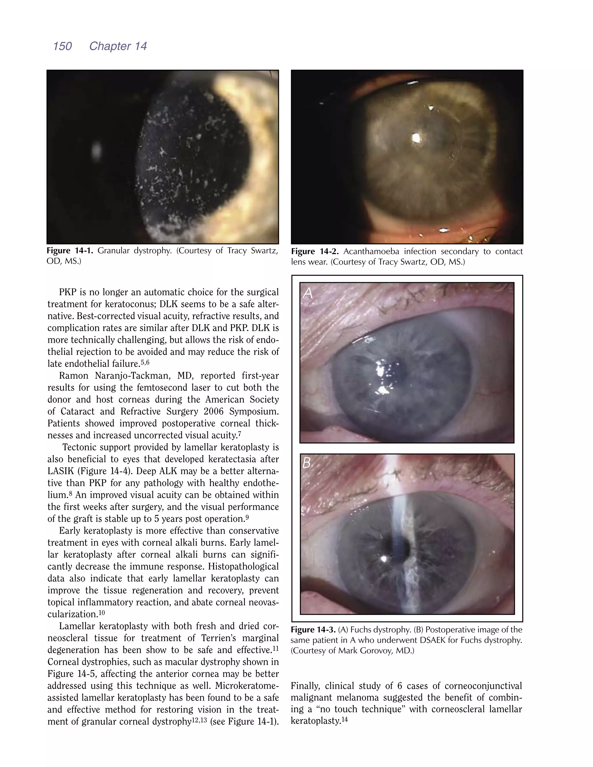 Lamellar Keratoplasty by Michael Duplessie | PDF