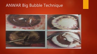 ANWAR Big Bubble Technique
 