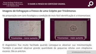 portaldeboaspraticas.iff.fiocruz.br
O EXAME A FRESCO DO CONTEÚDO VAGINAL
Imagens de Esfregaços a Fresco de uma Colpite por Tricômonas
Na preparação com soro fisiológico a condição de mais fácil identificação é a tricomoníase.
Tricomoníase – menor aumento Tricomoníase – maior aumento
O diagnóstico fica muito facilitado quando consegue-se observar sua movimentação.
Também é possível observar grande quantidade de pequenas células com citoplasma
escasso. São os piócitos.
 