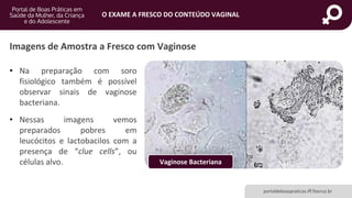 portaldeboaspraticas.iff.fiocruz.br
O EXAME A FRESCO DO CONTEÚDO VAGINAL
• Na preparação com soro
fisiológico também é possível
observar sinais de vaginose
bacteriana.
• Nessas imagens vemos
preparados pobres em
leucócitos e lactobacilos com a
presença de “clue cells”, ou
células alvo.
Imagens de Amostra a Fresco com Vaginose
Vaginose Bacteriana
 