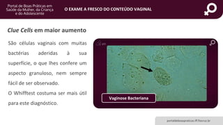 portaldeboaspraticas.iff.fiocruz.br
O EXAME A FRESCO DO CONTEÚDO VAGINAL
São células vaginais com muitas
bactérias aderidas à sua
superfície, o que lhes confere um
aspecto granuloso, nem sempre
fácil de ser observado.
O Whifftest costuma ser mais útil
para este diagnóstico.
Vaginose Bacteriana
Clue Cells em maior aumento
 