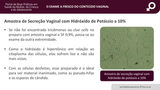 portaldeboaspraticas.iff.fiocruz.br
O EXAME A FRESCO DO CONTEÚDO VAGINAL
Amostra de Secreção Vaginal com Hidróxido de Potássio a 10%
• Se não foi encontrado tricômonas ou clue cells no
preparo com amostra vaginal e SF 0,9%, passa-se ao
exame da outra extremidade.
• Como o hidróxido é hipertônico em relação ao
citoplasma das células, elas sofrem lise e não são
mais vistas.
• Com as células desfeitas, esse preparado é o ideal
para ver material inanimado, como as pseudo-hifas
e os esporos de cândida.
Amostra de secreção vaginal com
hidróxido de potássio a 10%
 