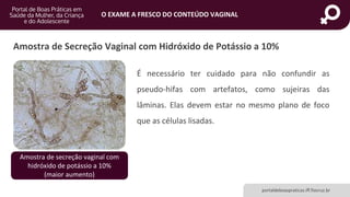 portaldeboaspraticas.iff.fiocruz.br
O EXAME A FRESCO DO CONTEÚDO VAGINAL
Amostra de Secreção Vaginal com Hidróxido de Potássio a 10%
É necessário ter cuidado para não confundir as
pseudo-hifas com artefatos, como sujeiras das
lâminas. Elas devem estar no mesmo plano de foco
que as células lisadas.
Amostra de secreção vaginal com
hidróxido de potássio a 10%
(maior aumento)
 