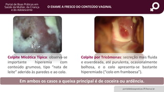 portaldeboaspraticas.iff.fiocruz.br
O EXAME A FRESCO DO CONTEÚDO VAGINAL
Colpite por Tricômonas: secreção mais fluida
e esverdeada, até purulenta, ocasionalmente
bolhosa, e o colo apresenta-se bastante
hiperemiado (“colo em framboesa”).
Colpite Micótica Típica: observa-se
importante hiperemia com
conteúdo grumoso, tipo “nata de
leite” aderido às paredes e ao colo.
Em ambos os casos a queixa principal é de coceira ou ardência.
 