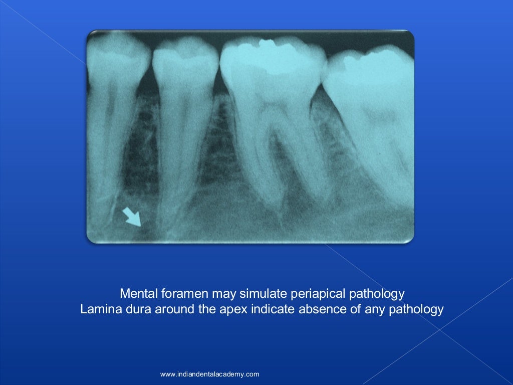 Lamina dura/ oral surgery courses