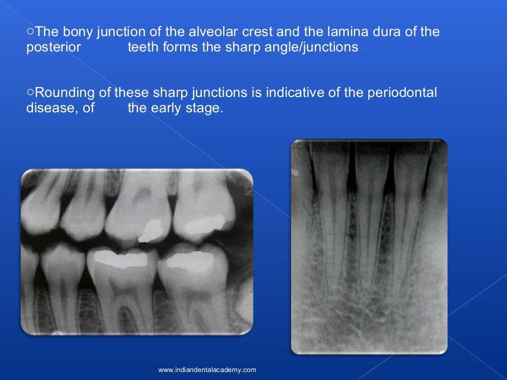 Lamina dura/ oral surgery courses