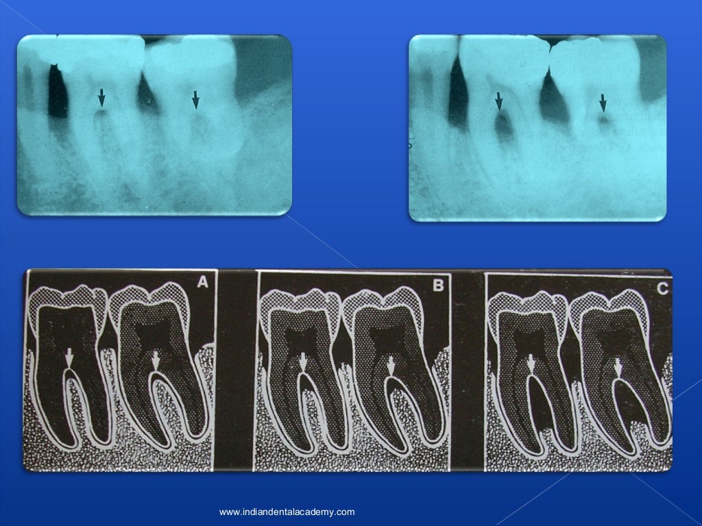 Lamina dura/ oral surgery courses