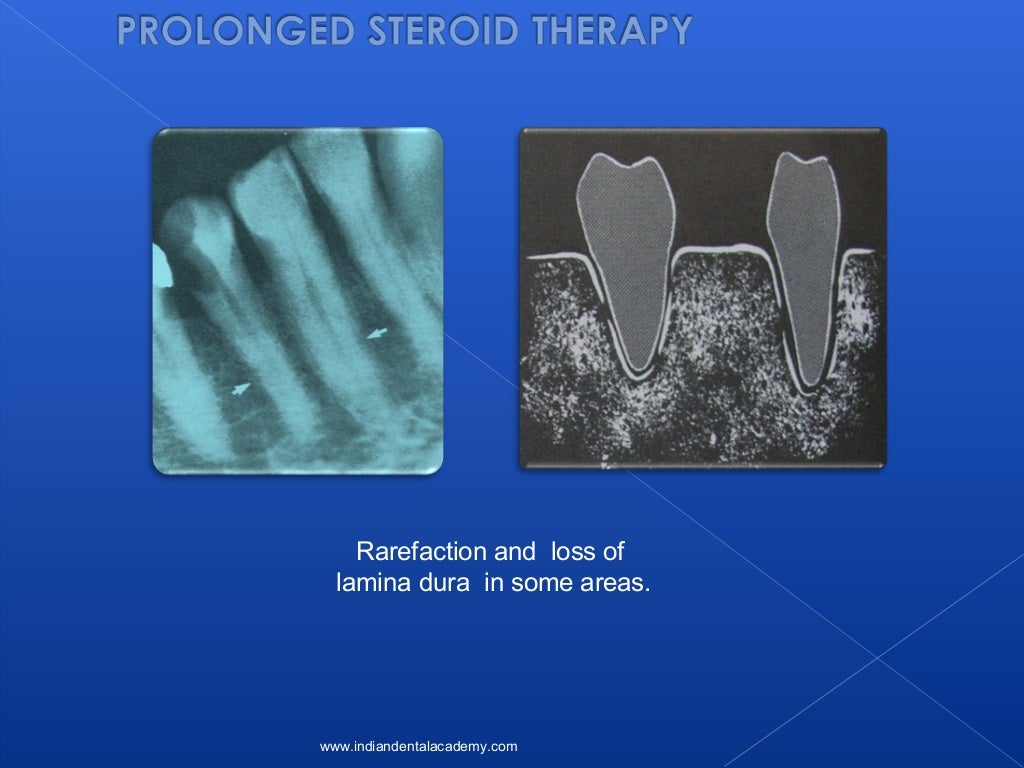 Lamina dura/ oral surgery courses