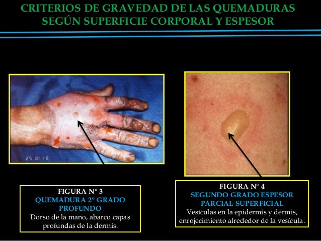 Laminas 10%lesiones
