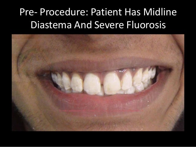 laminates veneers diastema