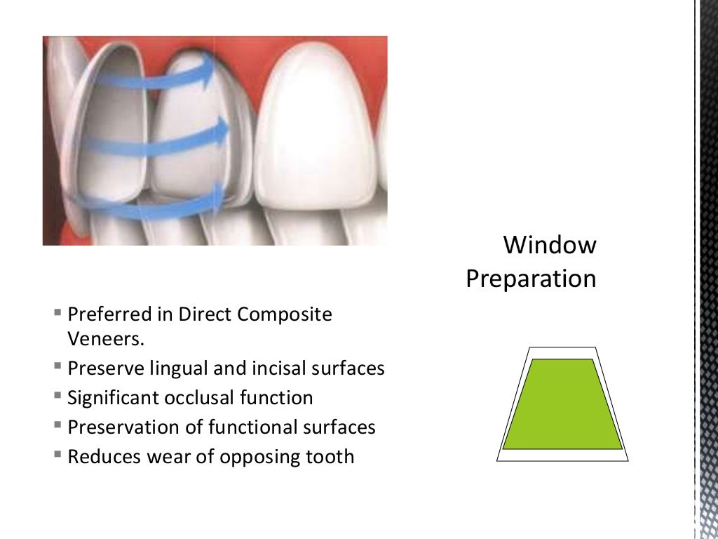 Dental Veneers & Laminates