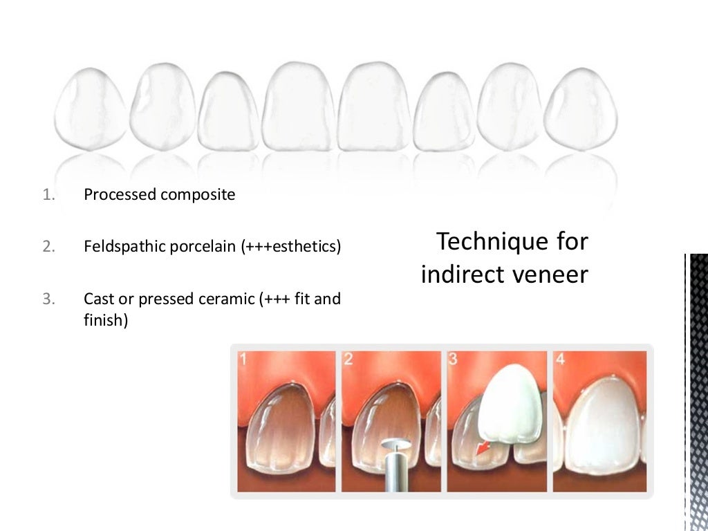 Dental Veneers & Laminates