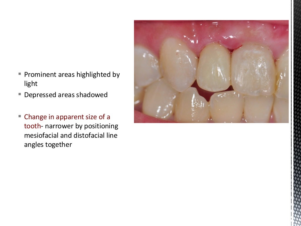 Dental Veneers & Laminates