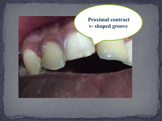 Proximal contract
v- shaped groove