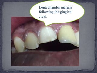 Long chamfer margin
following the gingival
crest.