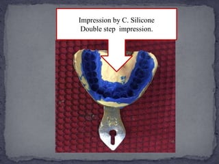 Impression by C. Silicone
Double step impression.