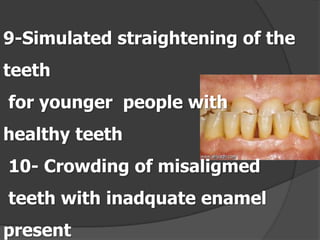 9-Simulated straightening of the
teeth
for younger people with
healthy teeth
10- Crowding of misaligmed

teeth with inadquate enamel
present

 