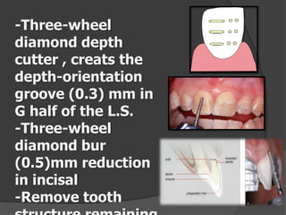 -Three-wheel
diamond depth
cutter , creats the
depth-orientation
groove (0.3) mm in
G half of the L.S.
-Three-wheel
diamond bur
(0.5)mm reduction
in incisal
-Remove tooth

 