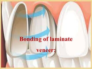 Bonding of laminate
veneer:

 