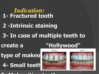 1- Fractured tooth

2 -Intrinsic staining
3- In case of multiple teeth to

create a

"Hollywood“

type of makeover
4- Small teeth.

 