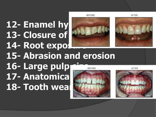 12- Enamel hypoplasia
13- Closure of diastemas
14- Root exposure
15- Abrasion and erosion
16- Large pulp size
17- Anatomical maleform teeth
18- Tooth wear

 