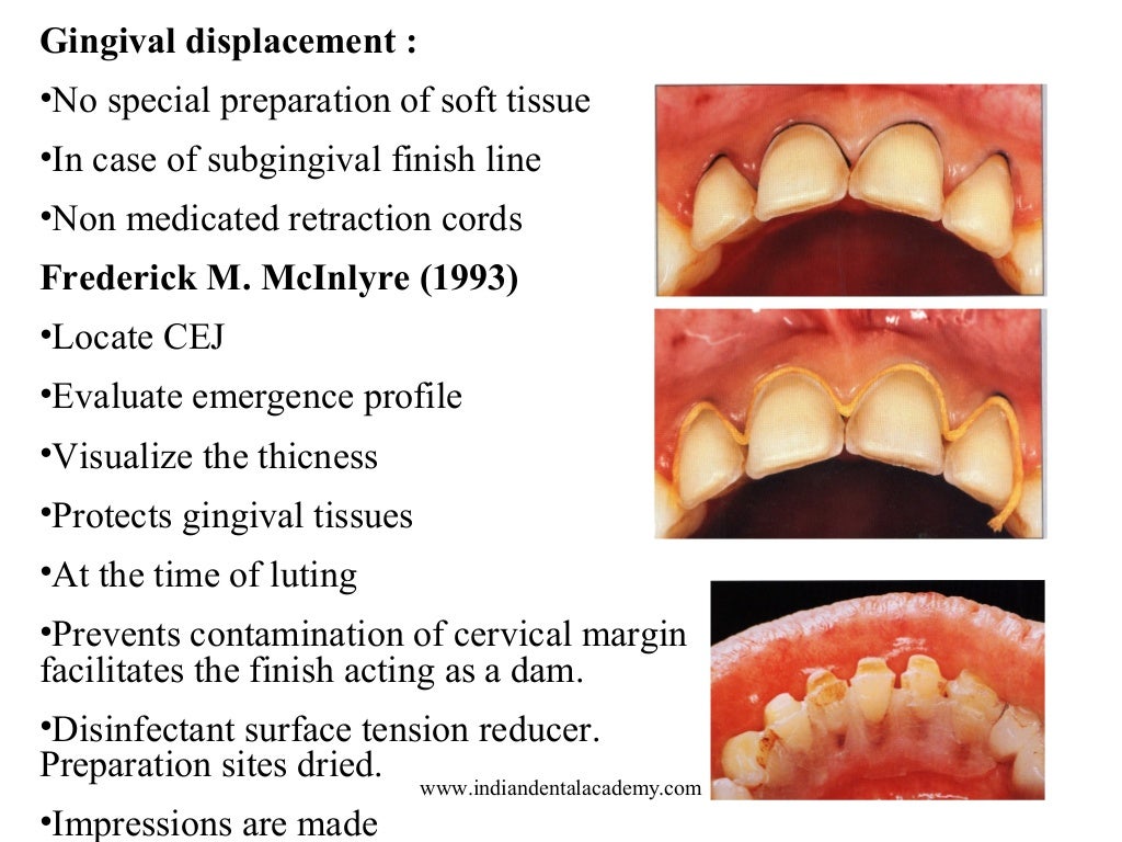 Laminate /dental courses