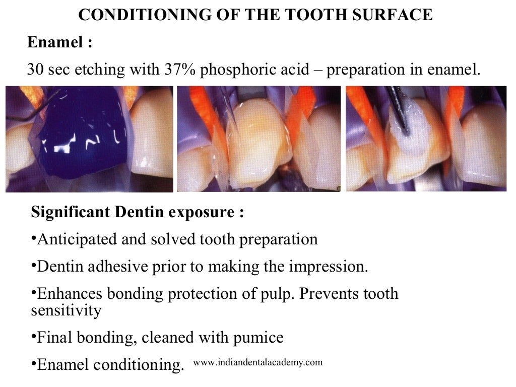Laminate /dental courses