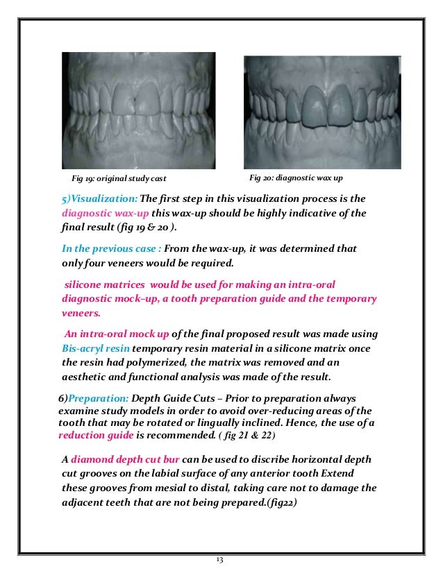 Laminate veneers by student at faculty of oral and dental medcine Ahr…
