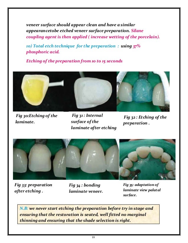 Laminate veneers by student at faculty of oral and dental medcine Ahr…