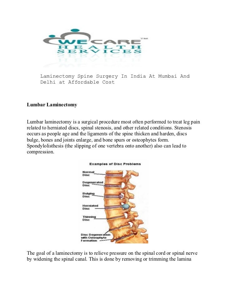 Laminectomy spine surgery in india at mumbai and delhi at affordable cost