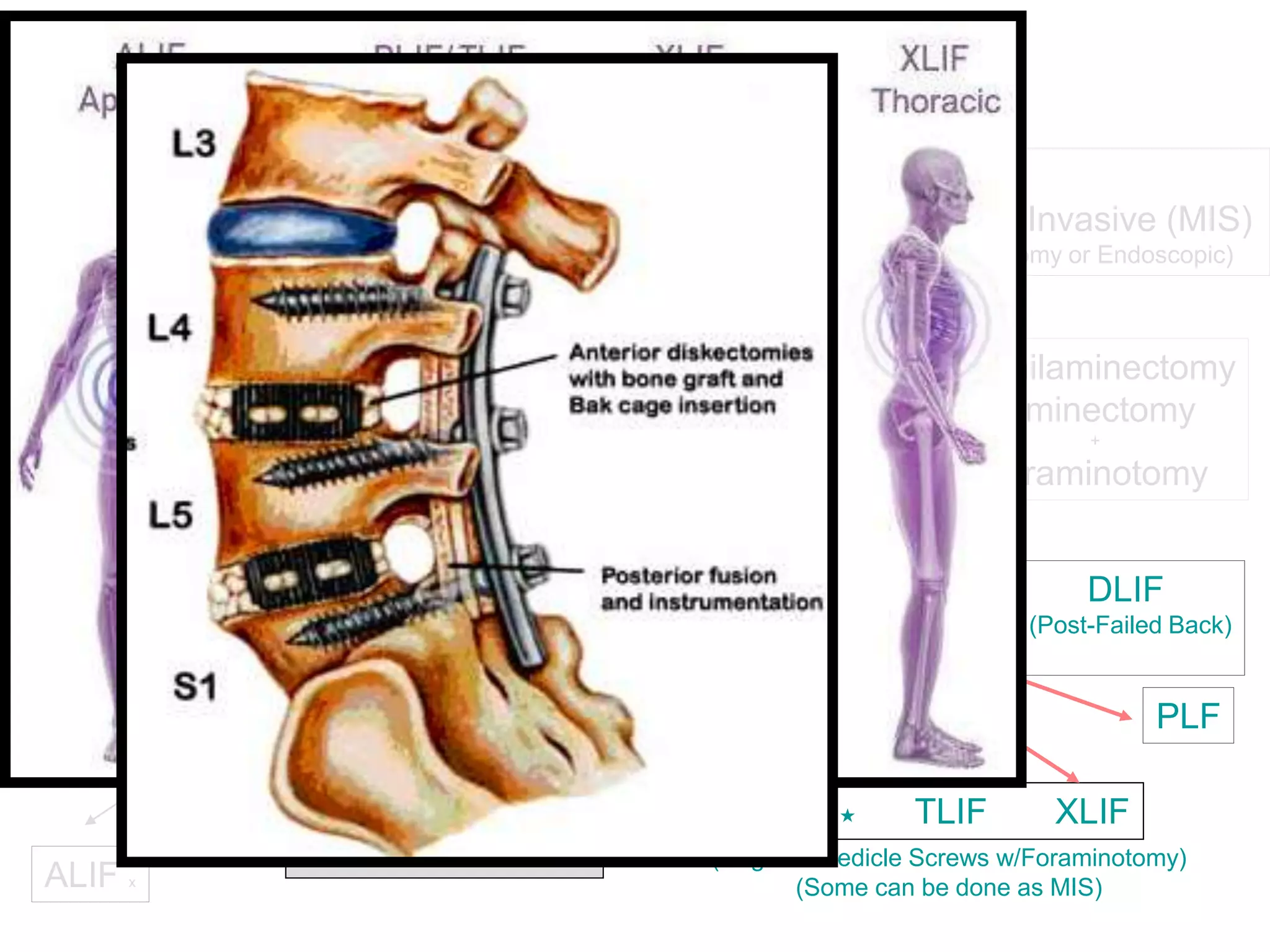 Curated visual reference: Visual Reference: Laminectomy Vs Discectomy In Rehabilitation