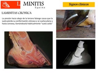 LAMINITISE q u i n a
Signos clínicos
LAMINITAS CRONICA
La presión hacia abajo de la tercera falange causa que la
suela pierda su conformación cóncava y se vuelva plana y
hasta convexa, llamándosela habitualmente "suela caída"
 
