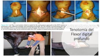Tenotomía del
Flexor digital
profundo
 
