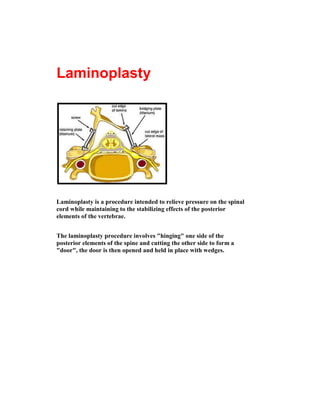 LaminoplastyLaminoplasty is a procedure intended to relieve pressure on the spinal cord while maintaining to the stabilizing effects of the posterior elements of the vertebrae. <br />The laminoplasty procedure involves quot;
hingingquot;
 one side of the posterior elements of the spine and cutting the other side to form a quot;
doorquot;
, the door is then opened and held in place with wedges.<br />Surgical procedure: the steps. Surgeon will perform an incision in your back, over the area that needs to be operated. The muscles that surround the spine are moved aside, to allow a clear view of the surgical site. A specific instrument is used to cut one groove on one side of the vertebra, aiming to create a hinge. The other side of the lamina is completely cut. The tip of the spinous process is removed. The lamina is then lifted and rotated, laterally moved like a door (often surgeons refer to this procedure as the “open door” procedure) The procedure relieves pressure immediately because the space for the nerves increases. The lamina, elevated and rotated, is then secured in the new position with a suture and small wedges of bone, inserted in the opened space    <br /> A laminoplasty, similar to a laminectomy, is often performed on patients suffering from spinal stenosis in the neck (narrowing of the cervical spinal canal). It is also referred to as an quot;
open-door laminoplasty.A laminoplasty creates more space for the spinal cord and roots. The actual procedure involves cutting a “hinge” into one side of the lamina and swinging it open like a door. It relieves pressure on the spinal cord by increasing the diameter of the spinal canal and room for the spinal cord. The surgery approach is through the back of the neck. This procedure creates excellent spinal canal decompression without the instability that may be created by multiple level cervical laminectomies.By relieving pressure on the spinal cord it is the goal of laminoplasty to stop the progression of damage to the spinal cord and allow for as much recovery of function as possible.<br />Contact  Detail :~<br />Please log on to :    http://www.spinesurgery-wecareindia.com<br />Please log on to :    http://www.spinesurgery-wecareindia.com/procedure/laminoplasty.html<br />contact Email  :    info@ spinesurgery-wecareindia.com<br />