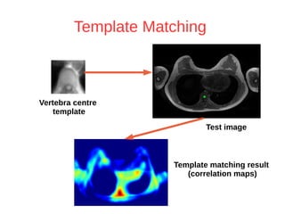 Template Matching 
Vertebra centre 
template 
Test image 
Template matching result 
(correlation maps) 
 