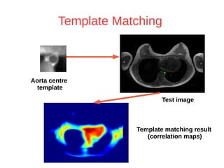 Template Matching 
Aorta centre 
template 
Test image 
Template matching result 
(correlation maps) 
 