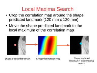 Local Maxima Search 
● Crop the correlation map around the shape 
predicted landmark (120 mm x 120 mm) 
● Move the shape predicted landmark to the 
local maximum of the correlation map 
Shape predicted landmark Cropped correlation map Shape predicted 
landmark + local maxima 
search 
 