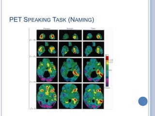 Cortical mapping of the language areas in the left cerebral cortex during neurosurgery