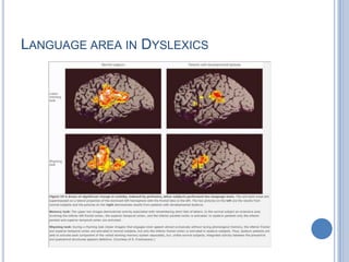 whereas the angular gyrus (together with the posterior cingulategyrus) seems more involved in semantic processing. 