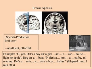 Brocas Aphasia „ Speech-Production Problem“ - nonfluent, effortful Example: “O, yea. Det's a boy an' a girl… an'… a… car… house… light po' (pole). Dog an' a… boat. ‘N det's a… mm… a… cofee, an' reading. Det's a… mm… a… det's a boy… fishin'.” (Elapsed time: 1 min 30 s) 