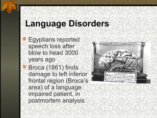 Language Disorders
 Egyptians reported
speech loss after
blow to head 3000
years ago
 Broca (1861) finds
damage to left inferior
frontal region (Broca’s
area) of a language
impaired patient, in
postmortem analysis
 