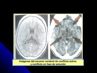 Imágenes del escaner cerebral de conflicto activo
y conflicto en fase de solución
 