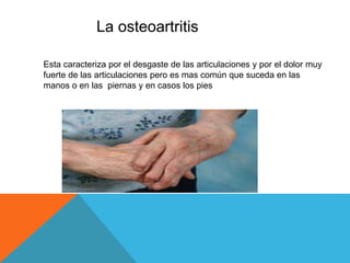 La osteoartritis 
Esta caracteriza por el desgaste de las articulaciones y por el dolor muy 
fuerte de las articulaciones pero es mas común que suceda en las 
manos o en las piernas y en casos los pies 
 