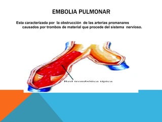 EMBOLIA PULMONAR 
Esta caracterizada por la obstrucción de las arterias promanares 
causados por trombos de material que procede del sistema nervioso. 
 
