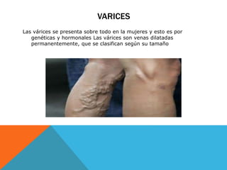 VARICES 
Las várices se presenta sobre todo en la mujeres y esto es por 
genéticas y hormonales Las várices son venas dilatadas 
permanentemente, que se clasifican según su tamaño 
 