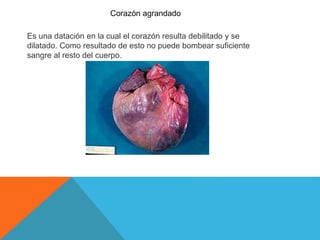 Corazón agrandado 
Es una datación en la cual el corazón resulta debilitado y se 
dilatado. Como resultado de esto no puede bombear suficiente 
sangre al resto del cuerpo. 
 