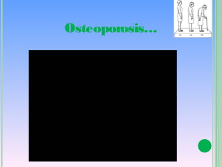 Osteoporosis…
 